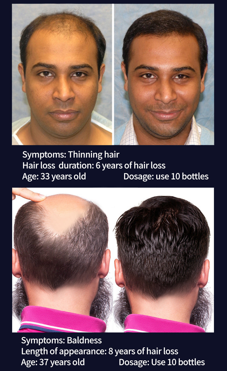 Super Growth- Anti-Hair Loss Oil