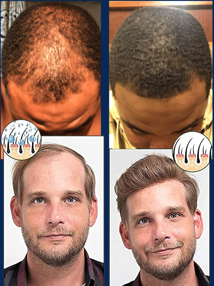Super Growth- Anti-Hair Loss Oil