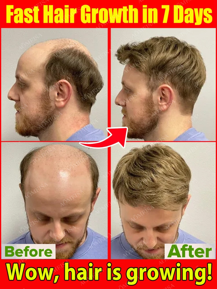 Super Growth- Anti-Hair Loss Oil