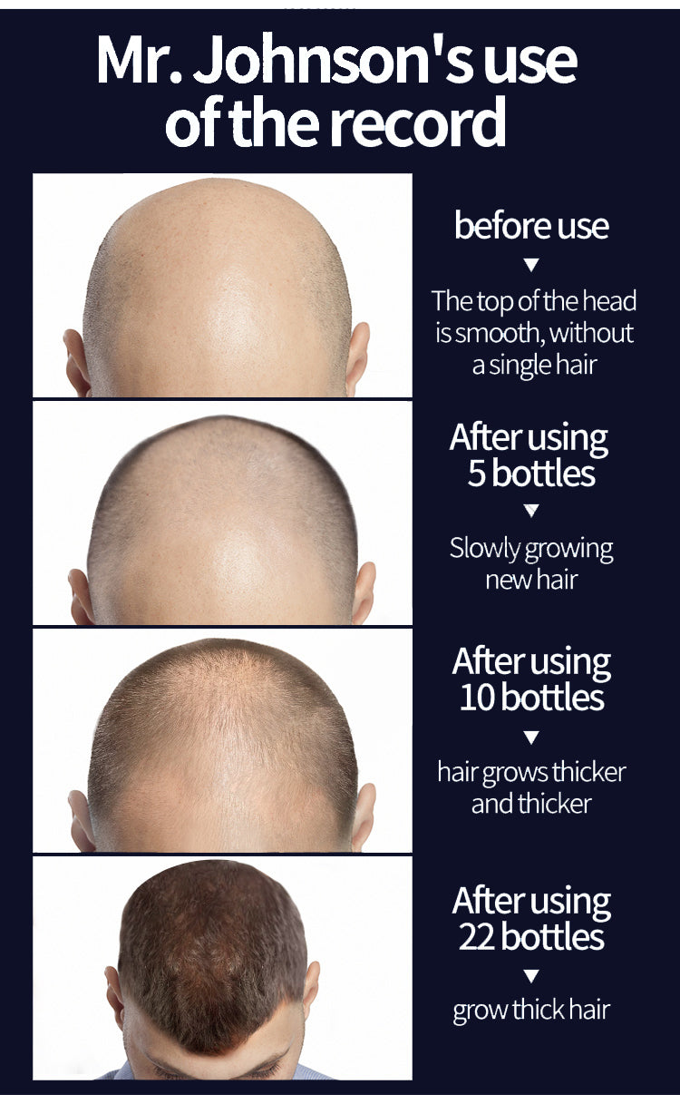 Super Growth- Anti-Hair Loss Oil