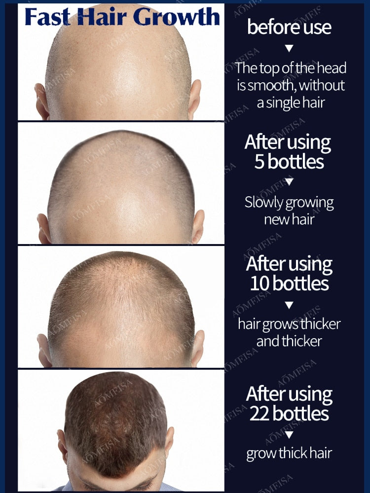 Super Growth- Anti-Hair Loss Oil