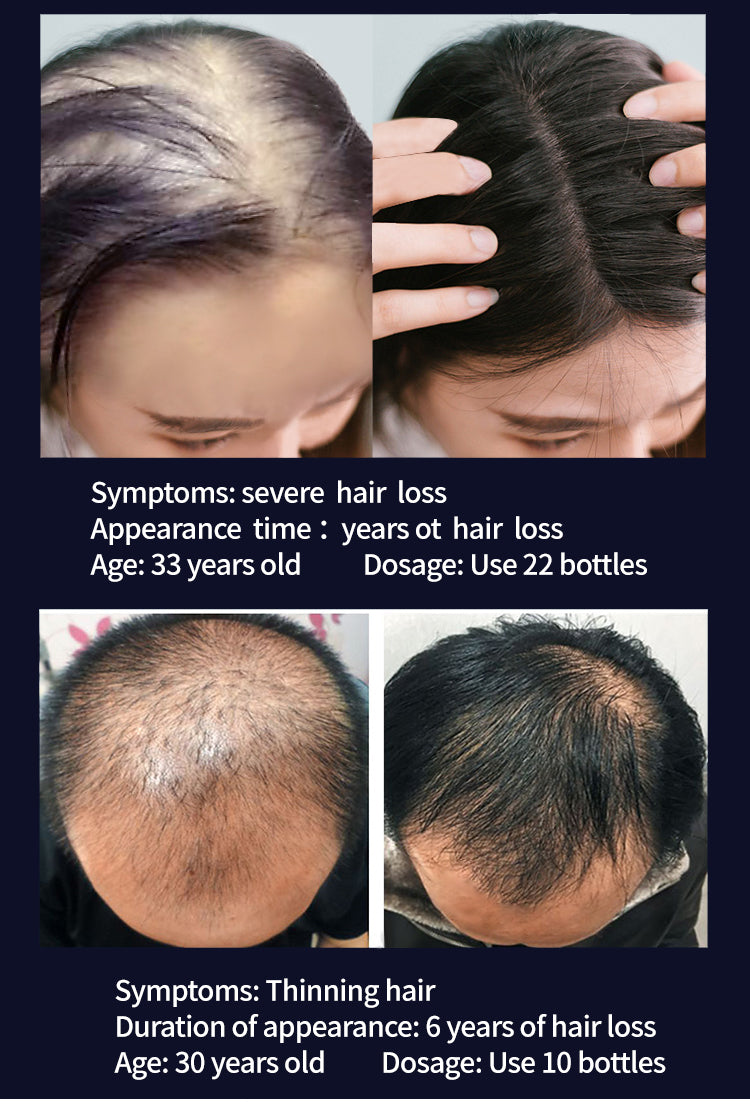 Super Growth- Anti-Hair Loss Oil